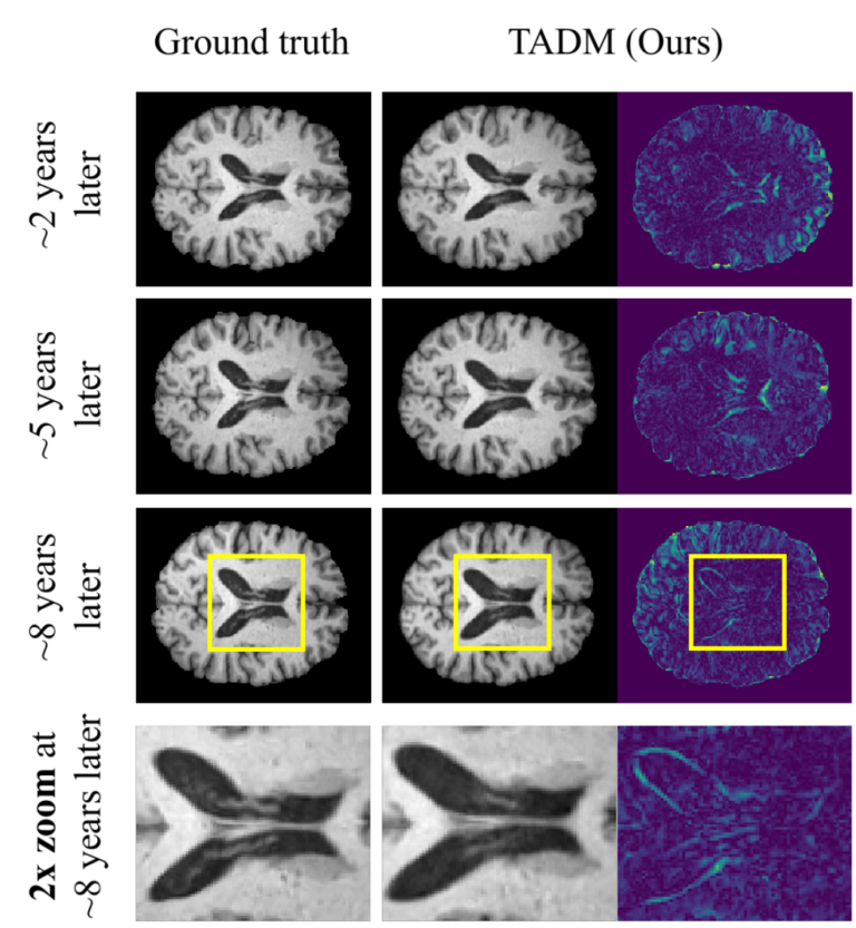 TADM TemporallyAware Diffusion Model for Neurodegenerative